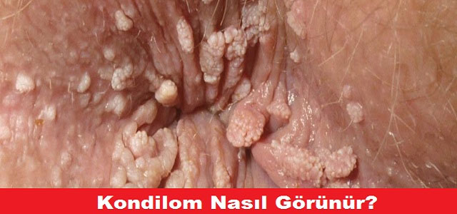 Condyloma acuminatum nedir. Tratamentul simptomelor viermilor și giardiei